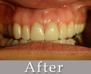 veneers_a