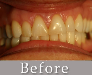 veneers_b